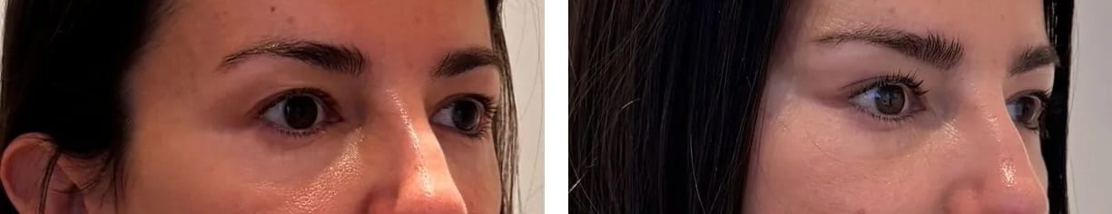 Cirugía de la Mirada caso 7 — antes y después